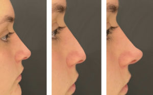 Importância da projeção da ponta nasal
