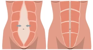 Ilustração da diástase abdominal mostrando o afastamento dos músculos retos