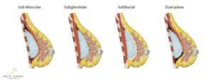 Variação dos planos de inserção da prótese de mama