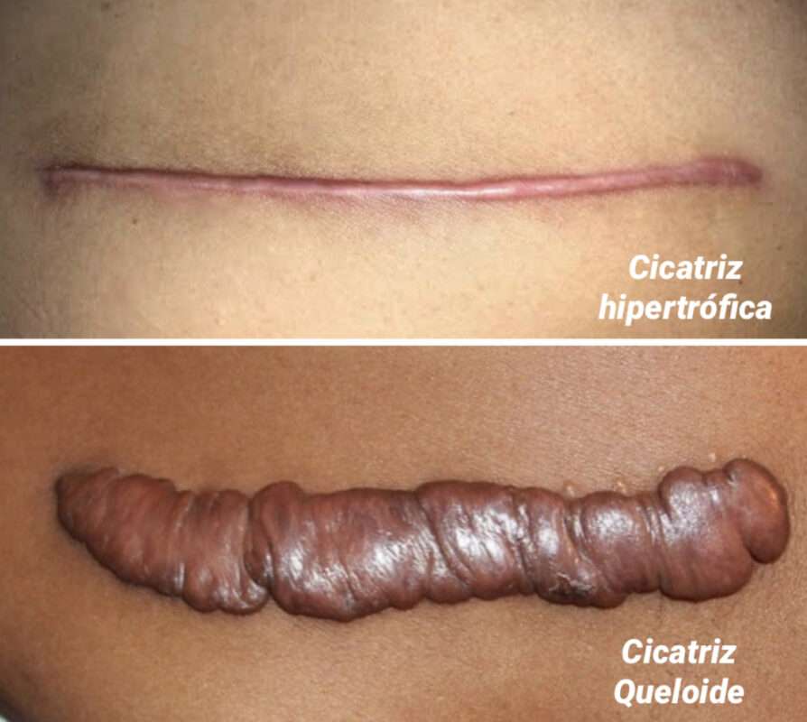 Ilustrar a diferença entre cicatriz queloide e hipertrófica