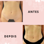 Lipo HD antes e depois