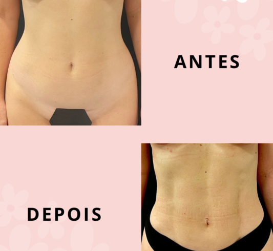 Lipo HD antes e depois