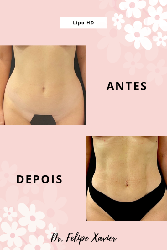 Lipo HD antes e depois