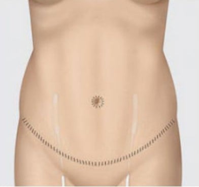 imagem ilustrando uma abdominoplastia tradicional