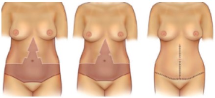 Imagem ilustrando uma abdominoplastia em âncora