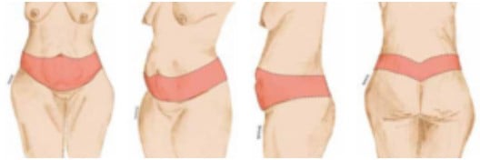 Imagem ilustrando uma abdominoplastia circunferencial