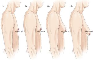 Classificação da ginecomastia