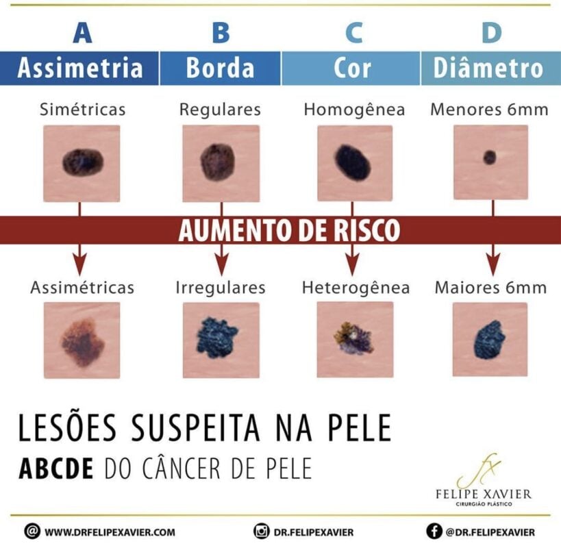 Como identificar uma lesão suspeita de pele Dr Felipe Xavier