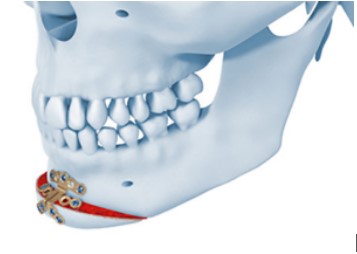 Avanco de maxila e recuo de mandibula - Ortognatica - Dr Felipe