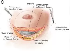 Ilustração cirúrgica mostrando a fixação do sulco inframamário com pontos profundos, técnica conhecida como sutiã interno, utilizada para aumentar a sustentação e a estabilidade da mama na mastopexia.